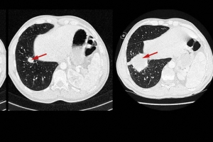항암면역요법 무턱대고 썼다가는 암 더 키운다