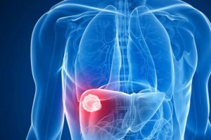 [달콤한 사이언스] 간암세포 이제는 굶겨서 없앤다