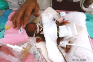 정상으로 성장한 세계에서 가장 작게 태어난 미숙아