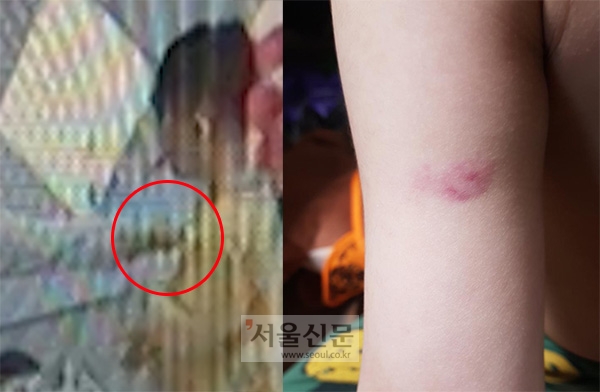 4월 22일 인천 남동구 논현동의 한 어린이집 보육교사가 식판을 반납하던 6살 아이의 팔을 꼬집고 있다(사진왼쪽). 아이 팔에 생긴 피멍.