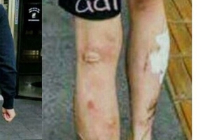 [종합] 팬조차 의아했던 박유천 다리 상처