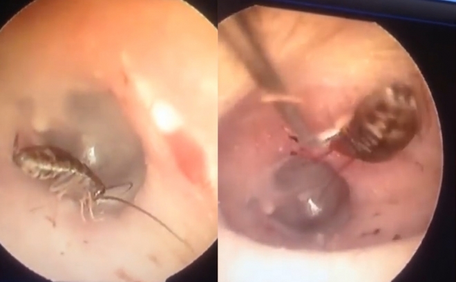 베트남 바 자이언트주 한 병원에서 귓속에 들어간 바퀴벌레를 빼내는 모습(유튜브 영상 캡처)