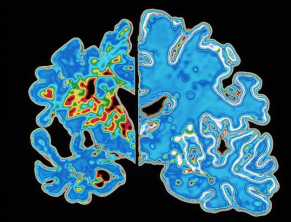 치매 환자의 뇌(왼쪽)과 건강한 이의 뇌.