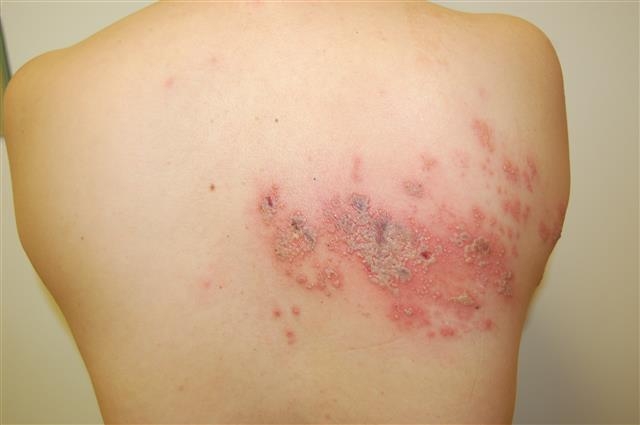 대상포진 환자의 피부 병변. 작은 수포들이 띠 모양을 이루며 군집해 있다. 서울아산병원 제공