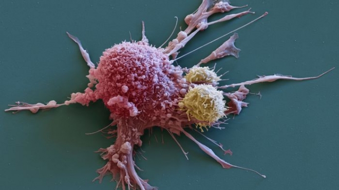 암세포의 전자현미경 모습 네이처 제공