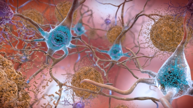 알츠하이머 치매 질환의 주범으로 알려진 베타 아밀로이드 단백질과 타우 단백질이 뇌 신경세포에 미치는 영향을 이미지화한 그래픽.  미국국립보건원 노화연구소