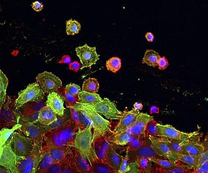 대장암세포의 현미경 사진