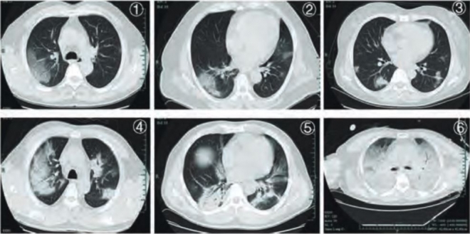 백색폐렴을 보이는 코로나 환자의 폐 출처:알리바바공익기금회