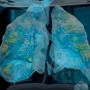 코로나19 환자 폐, VR로 봤더니…“폐손상 가능성”