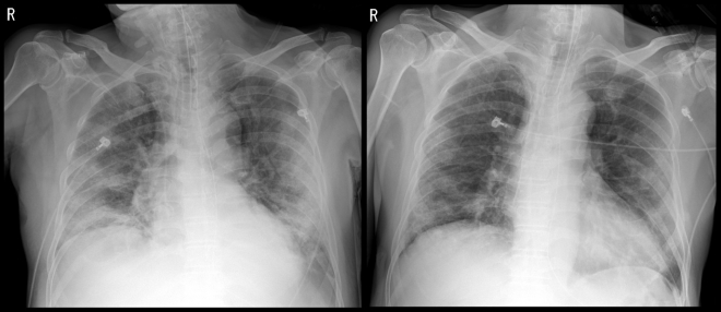 코로나19 중증환자 김모씨의 혈장치료를 받기 전(왼쪽)과 후(오른쪽)의 흉부 엑스레이 영상. 혈장치료 후 폐렴 등으로 뿌옇게 보이던 폐가 나아지고 있다. 세브란스병원 제공