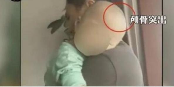 중국서 가짜 분유로 머리가 커진 유아 신경보 캡처.