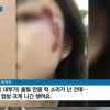 “명백한 여성혐오 범죄” 서울역 묻지마 폭행, 30대女 광대뼈 함몰