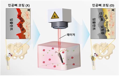 국내 연구진 임플란트 결합기간 단축, 염증차단 기술 개발