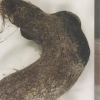 “배 아파요” 병원 갔던 러 소녀 배에서 머리카락 뭉치가 쑥