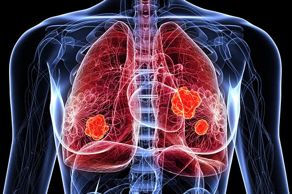 혈액검사로 폐암 조기진단, 5년 생존률 예측 기술 개발됐다