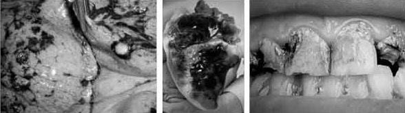 왼쪽부터 폐암-심장질환-치아 변색 순. 보건복지부 제공