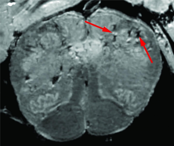 고출력 MRI로 측정한 코로나19 사망자의 뇌
