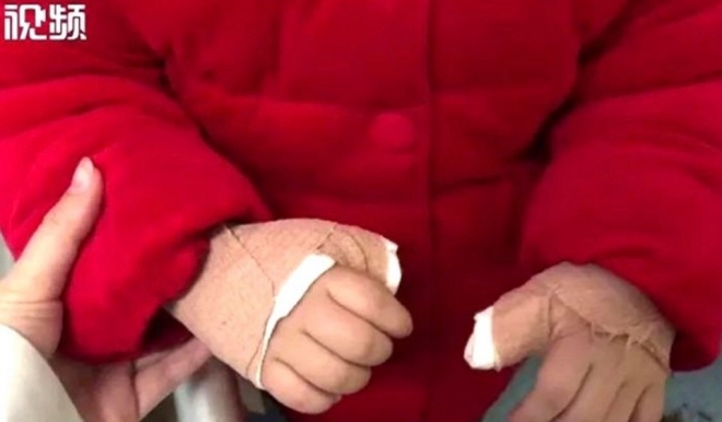 엄지손가락 ‘건막염’ 수술받은 3세 아기/트위터 캡처
