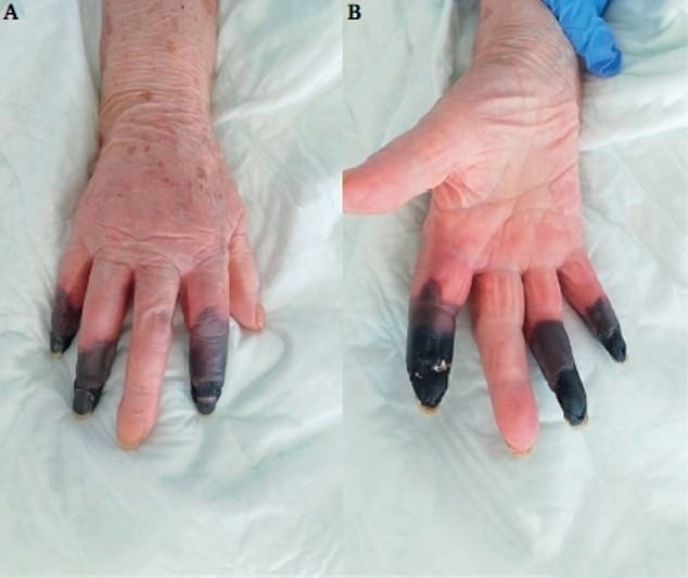 코로나19로 검게 변한 노인의 손가락.  유럽혈관외과학회지
