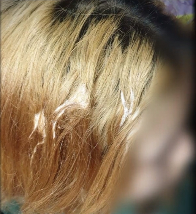 또래들로부터 폭행과 괴롭힘을 당한 다문화가정 중학생. 머리카락에 껌이 엉겨 붙어 있다.  UBC 캡처