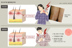 밤마다 긁적긁적 만성 두드러기… 환자 70% ‘원인 아리송’