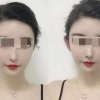 중국 젊은층 얼굴 작아보인단 이유로 ‘엘프 귀’ 성형 인기
