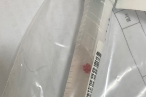 60대 아스트라제네카 백신 접종 후 뇌졸중으로 의식불명