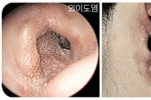 ‘간질먹먹’ 귀 ‘화끈따끔’ 피부…꿀 휴가, 쿨하지 못해 미안해