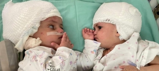 머리가 붙은 채 태어난 이스라엘 샴쌍둥이의 분리 수술이 성공적으로 진행된 이후 쌍둥이가 서로를 마주 보고 있다. 로이터 연합뉴스
