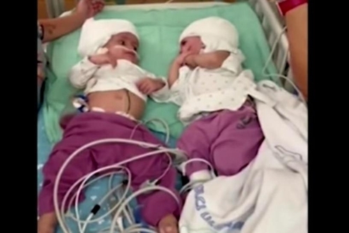 머리가 붙은 채 태어난 이스라엘 샴쌍둥이의 분리 수술이 성공적으로 진행된 이후 쌍둥이가 서로를 마주 보고 있다. 로이터