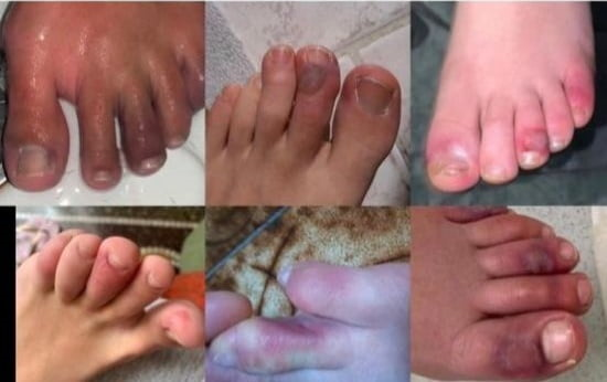 ‘코로나 발가락’ 증상을 겪고있는 발. 소아과 전문의 Dawn Wahezi 트위터 캡처