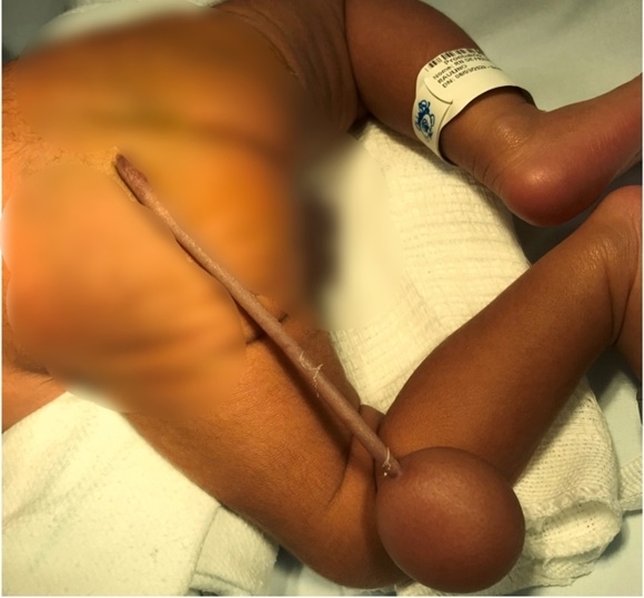 브라질에서 태어난 한 신생아의 엉덩이에 꼬리와 공이 달린 모습. 더선 캡처
