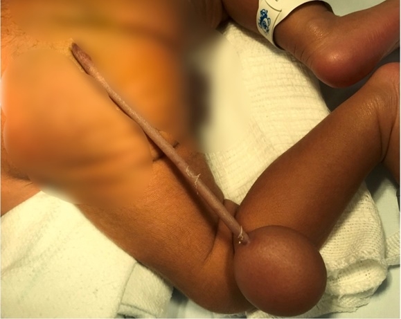 브라질에서 태어난 한 신생아의 엉덩이에 꼬리와 공이 달린 모습. 더선 캡처.