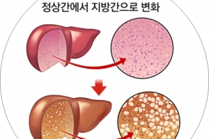 늘 피곤한 김 부장, 오른쪽 상복부 통증 땐 지방간 의심하세요