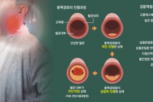 잠깐이라도 한쪽 마비 왔다면… ‘혈관 고속도로’ 확인하세요