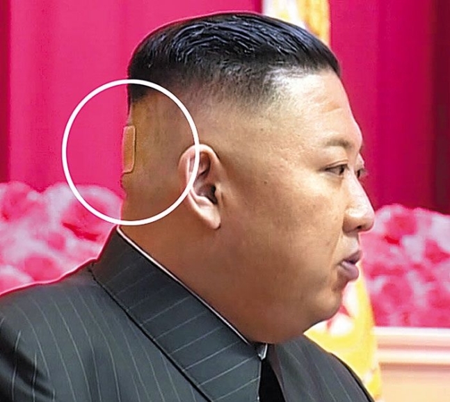 김정은 북한 국무위원장 뒤통수에 의료용 테이프 자국. 조선중앙TV 연합뉴스