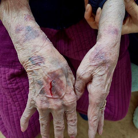 경북 김천 노인보호센터의 원장과 요양보호사들에게 폭행 당해 80대 할머니의 손과 팔에 온통 멍이 들고 손목에서 피가 흐르는 모습. 할머니 가족측 제공