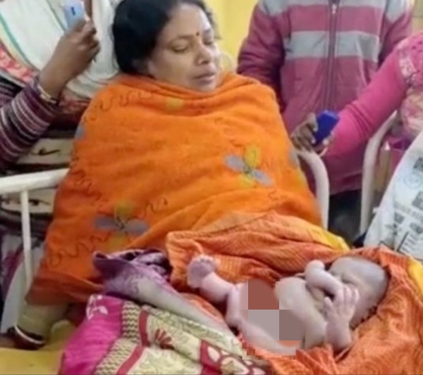 인도에서 동부의 사다르 병원에서 팔과 다리가 각각 4개인 아기가 태어났다. 외신 캡처