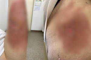 軍 훈련병 “격리 중 화상…캔음료 주고 방치했다” 호소