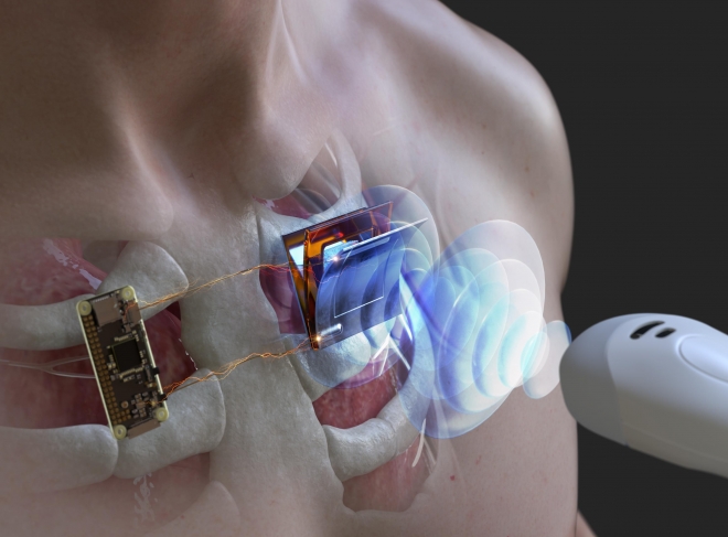 초음파로 무선 전력 충전 초음파 프로브를 이용해 신체 삽입형 전자기기의 구동을 위한 전력을 무선충전하는 개념도  KIST 제공