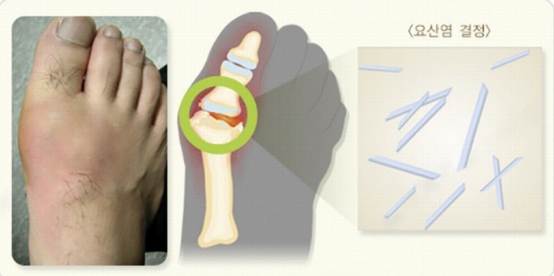 급성 통풍 발작 <자료: 질병관리청 국가건강정보포털>