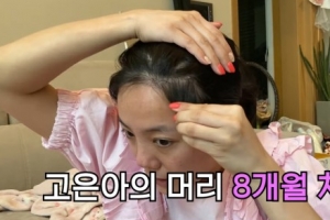 고은아, 모발 이식 전후 사진 공개