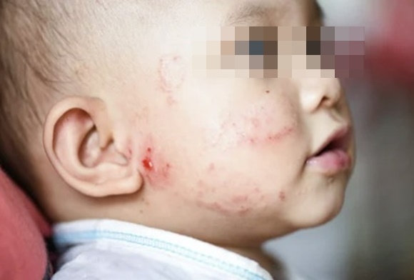 임신 중 비타민D 보충제를 복용하면 출산한 아기가 출생 첫해에 난치성 피부질환인 아토피성 피부염(atopic eczema) 위험이 크게 줄어든다는 연구 결과가 나왔다. 아토피성 피부염 자료 사진 123RF