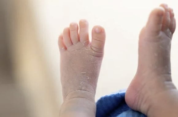 임신 중 비타민D 보충제를 복용하면 출산한 아기가 출생 첫해에 난치성 피부질환인 아토피성 피부염(atopic eczema) 위험이 크게 줄어든다는 연구 결과가 나왔다. 아토피성 피부염 자료 사진.123RF