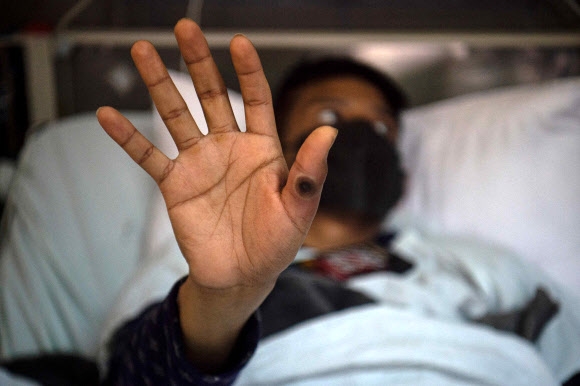 손에 난 병변을 들어보이고 있다.  페루 리마의 원숭이두창 환자가 손에 난 병변을 들어보이고 있다. AFP연합뉴스