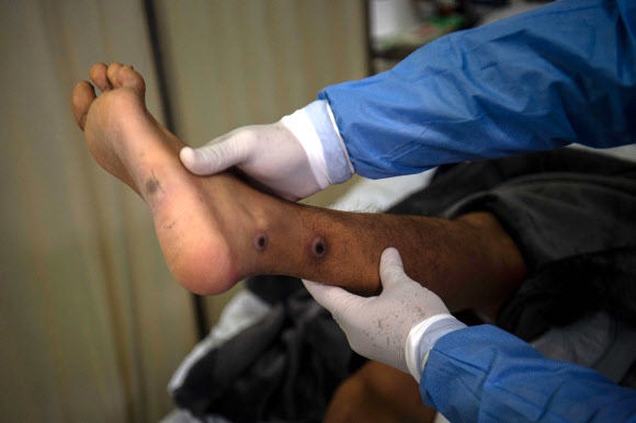 다리에도... 페루 리마의 원숭이두창 환자가 손에 난 병변을 들어보이고 있다. AFP연합뉴스