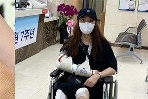 민지영, 오토바이 사고 후…여전히 가득한 피멍