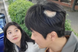 ‘손태영♥’ 권상우, 원형 탈모 어쩌나…손바닥만 하네