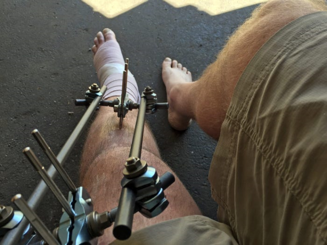 다리 늘리기 시술에는 상당한 통증이 수반되며 아무리 빨라도 3개월 정도 휠체어에 앉아 지내야 할 정도로 쉽지 않다.