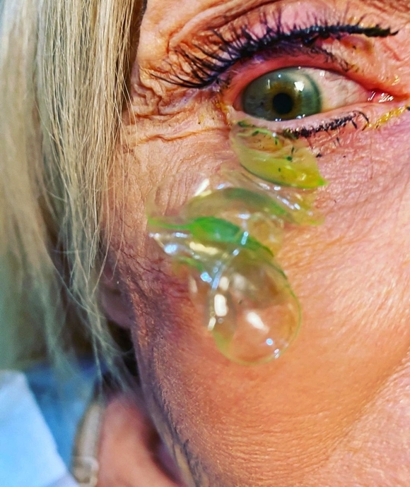 9월 30일(현지시간) 미국 캘리포니아주 뉴포트 비치 안과전문의 카테리나 쿠르테바가 70대 중반 여성 환자 눈에서 콘택트렌즈 23개를 제거했다고 밝혔다. 2022.9.30  카테리나 쿠르테바 인스타그램